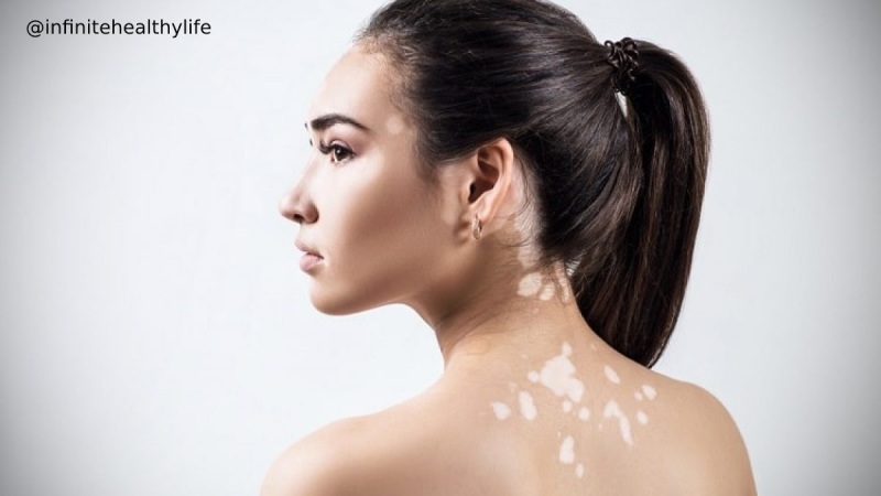 White Patches on Skin Remedies